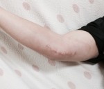 手術の跡はこうなっています。